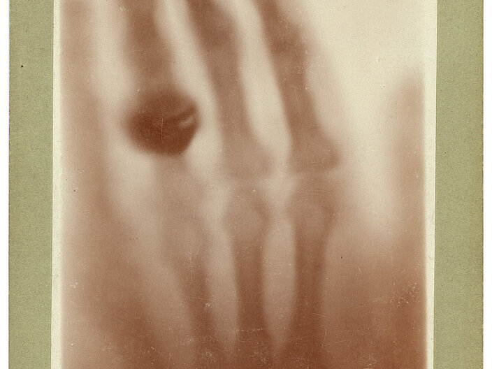 Röntgenbild einer linken Hand mit einem Ring am Ringfinger.