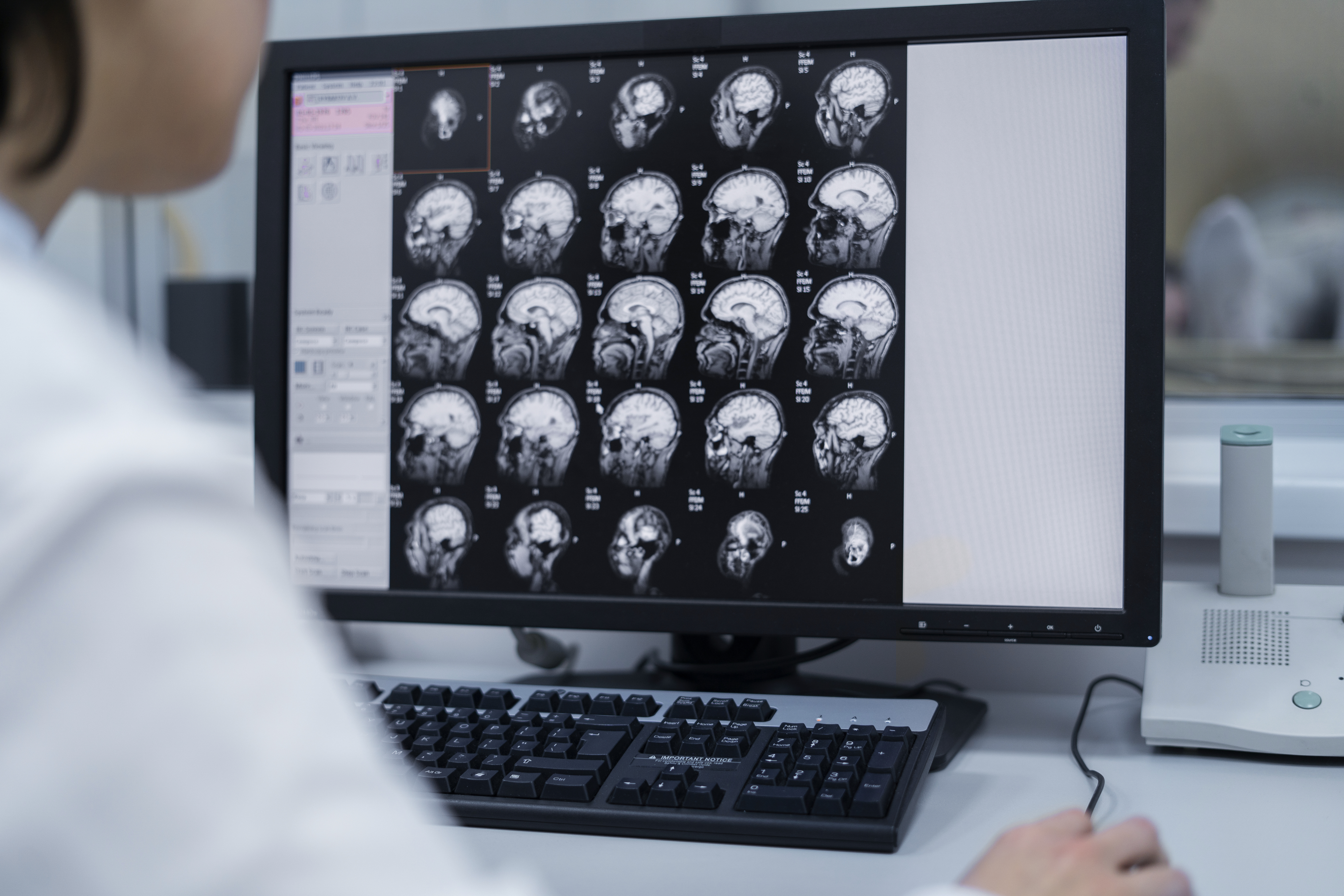 Abbildung eines Computerbildschirm mit EEG Scans eines Gehirns